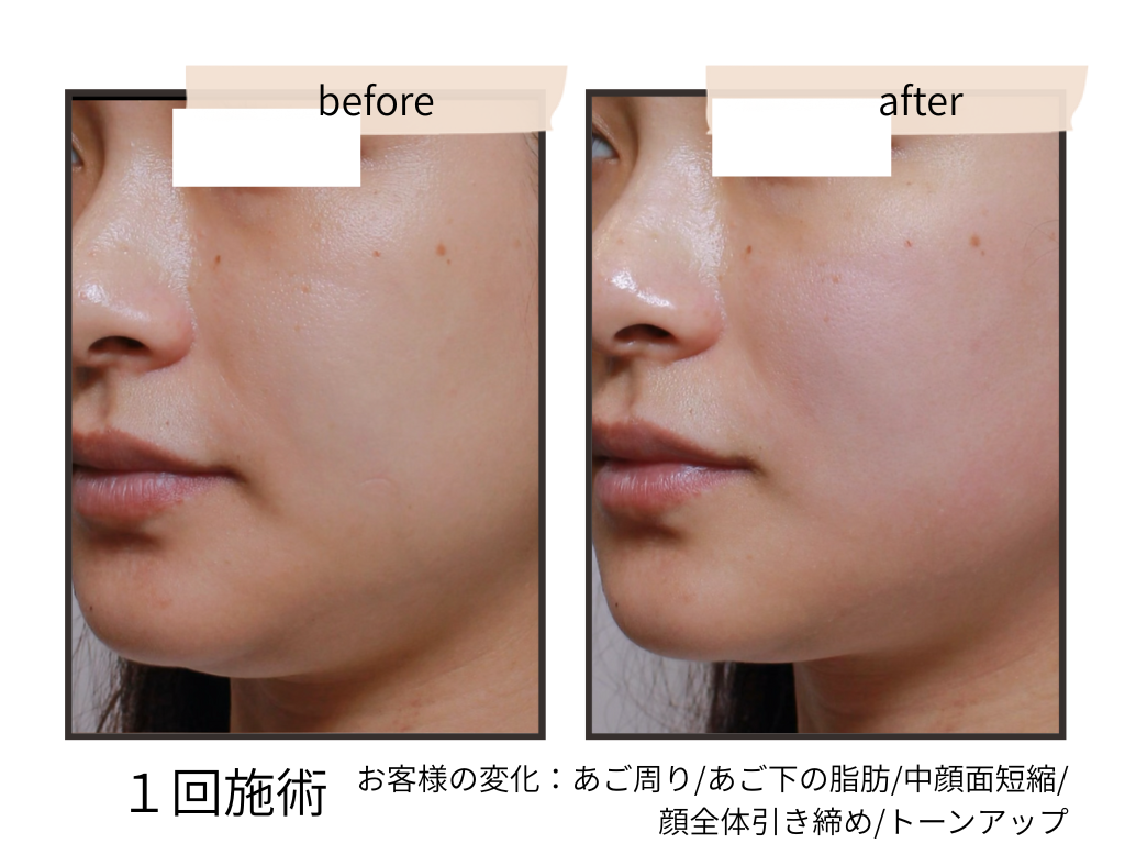 【人気No.2】二重あご脂肪分解×小顔フェイシャル ￥15,000→￥9,900（１２０分）