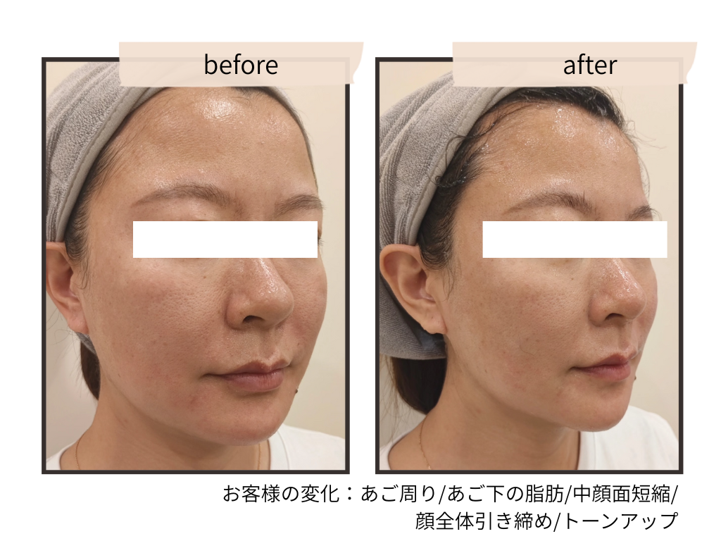 【人気No.1】たるみ×毛穴洗浄｜若見え透明肌プラチナケア￥15000→￥9900（１２０分）