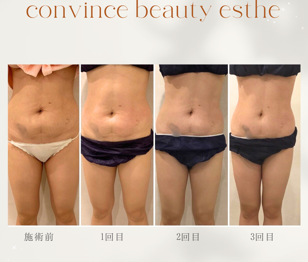 【痩身脂肪溶解】1箇所 ￥10000