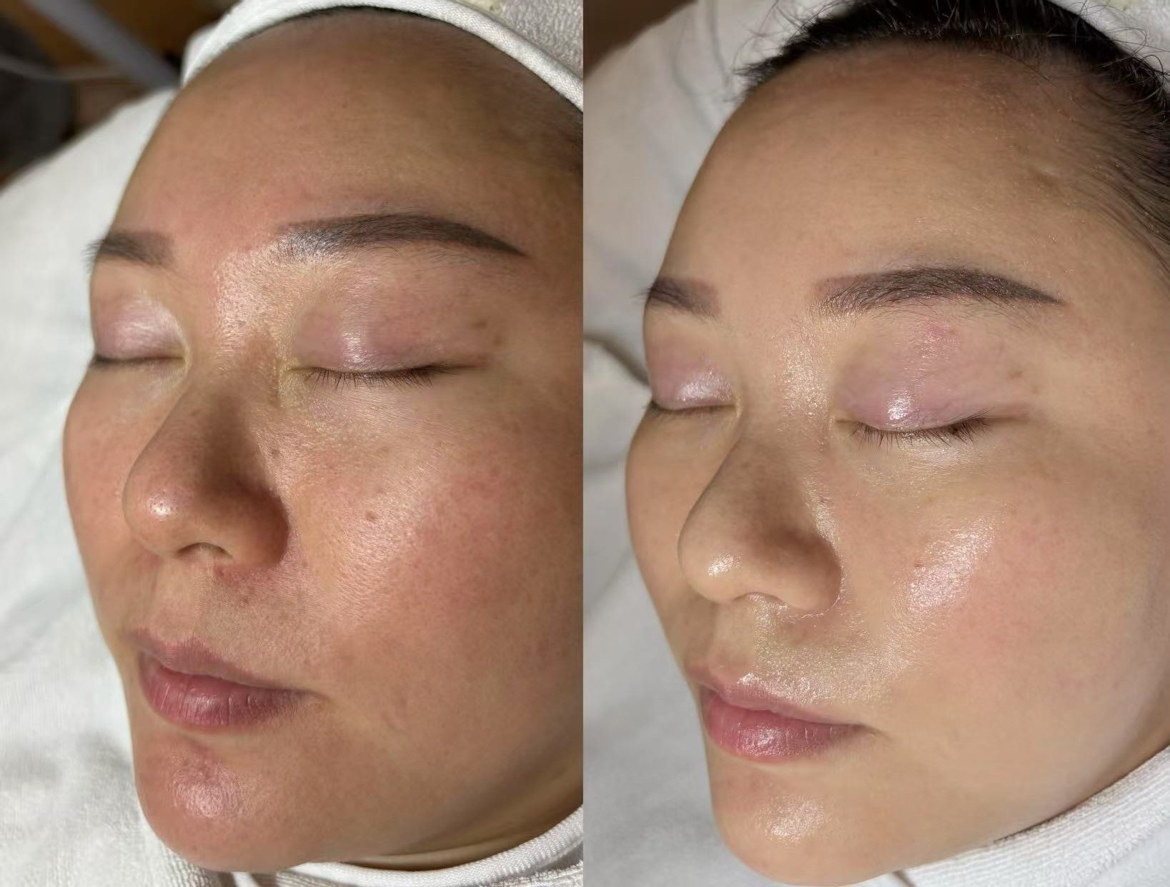 【駆け込みブライダルフェイシャル】フェイスライン＋デコルテ＋肩首ケア