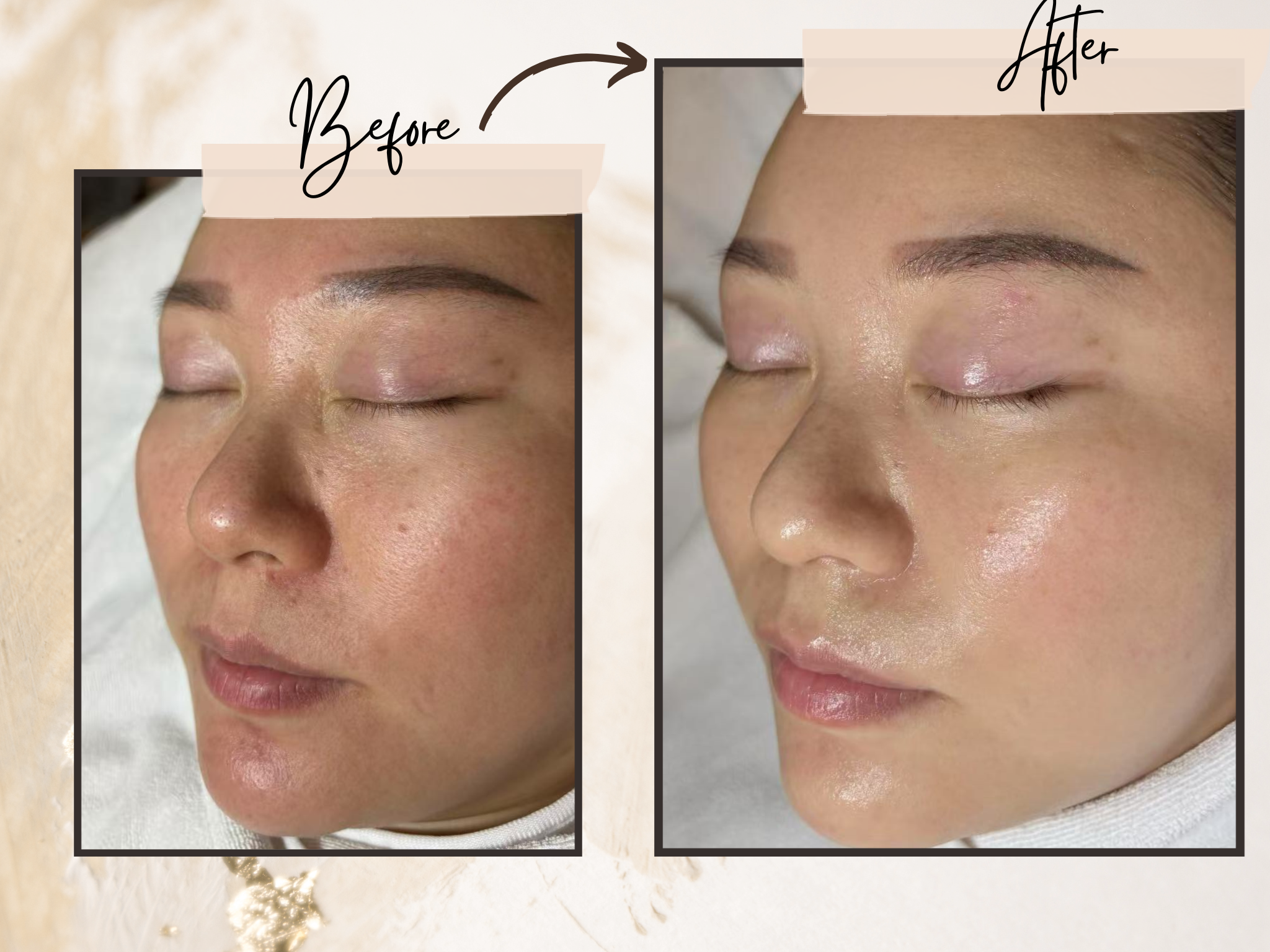 【毛穴革命】ピーリング×幹細胞成長因子プレミアムケア￥15000→￥9900（１２０分）